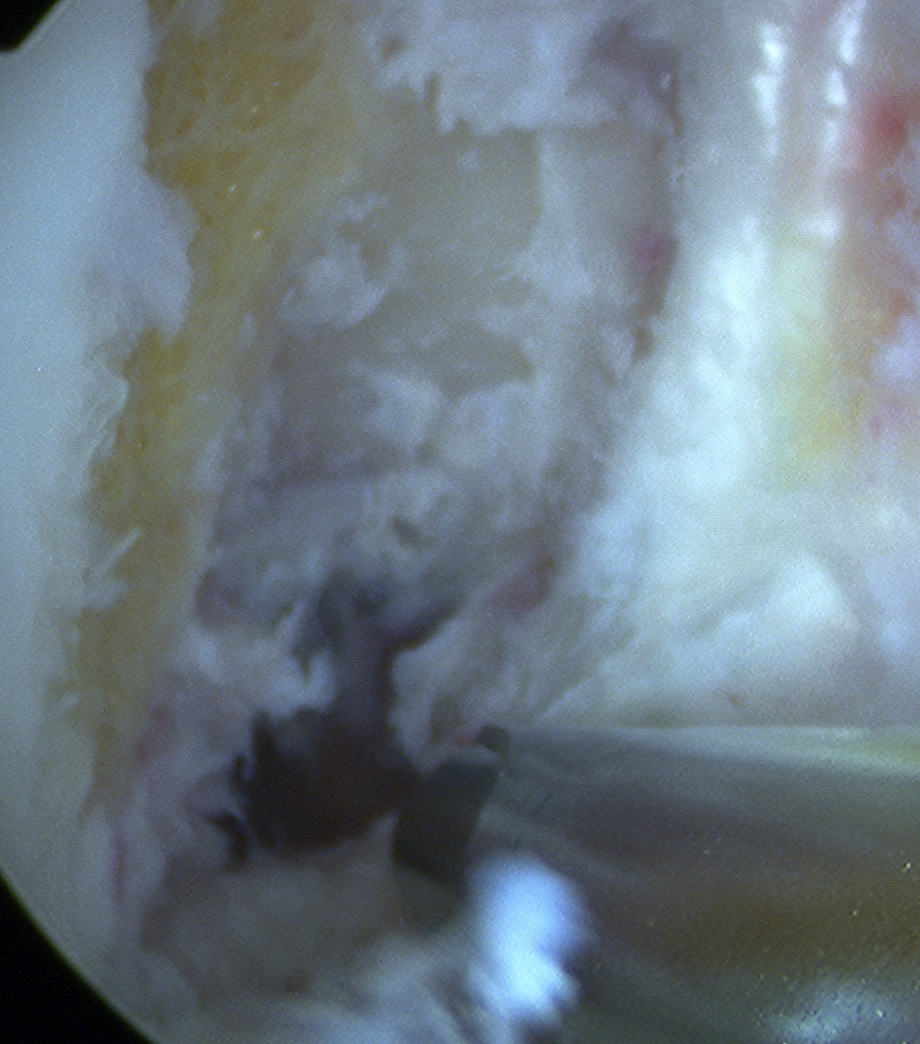 ACL Post Notchplasty